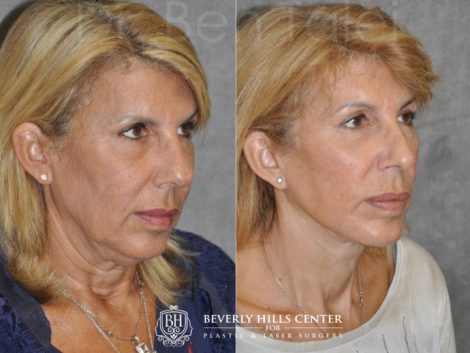AuraLyft, Lower Eyelid Rejuvenation & Minimally Invasive Rhinoplasty - Right Side