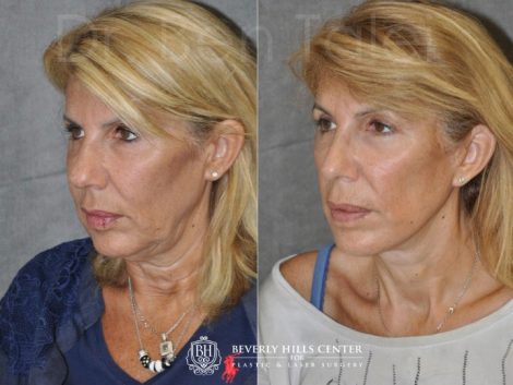 AuraLyft, Lower Eyelid Rejuvenation & Minimally Invasive Rhinoplasty - Left Side