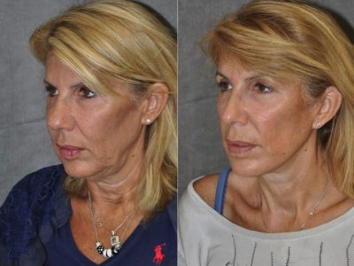 AuraLyft, Lower Eyelid Rejuvenation & Minimally Invasive Rhinoplasty - Left Side