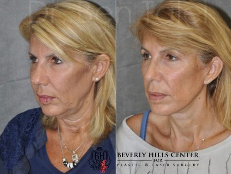 AuraLyft, Lower Eyelid Rejuvenation & Minimally Invasive Rhinoplasty - Left Side
