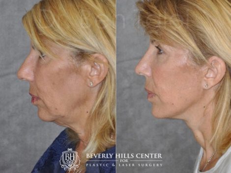 AuraLyft, Lower Eyelid Rejuvenation & Minimally Invasive Rhinoplasty - Left Side