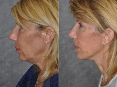 AuraLyft, Lower Eyelid Rejuvenation & Minimally Invasive Rhinoplasty - Left Side