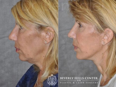 AuraLyft, Lower Eyelid Rejuvenation & Minimally Invasive Rhinoplasty - Left Side