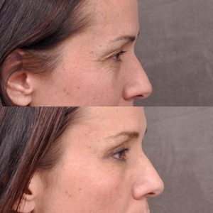 Upper Blepharoplasty and Endoscopic Brow Lift - Right Side