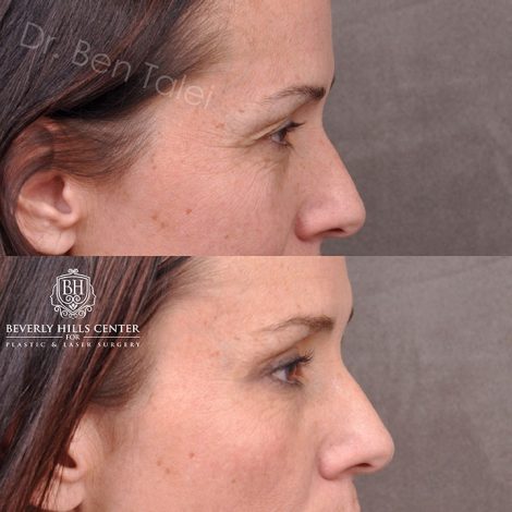 Upper Blepharoplasty and Endoscopic Brow Lift - Right Side