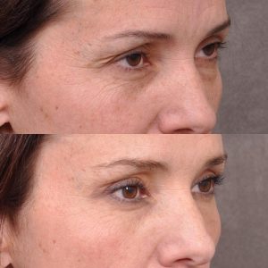 Upper Blepharoplasty and Endoscopic Brow Lift - Right Side