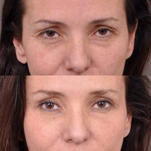 Upper Blepharoplasty and Endoscopic Brow Lift - Front