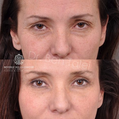 Upper Blepharoplasty and Endoscopic Brow Lift - Front
