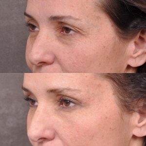 Upper Blepharoplasty and Endoscopic Brow Lift - Left Side