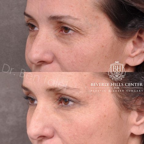 Upper Blepharoplasty and Endoscopic Brow Lift - Left Side