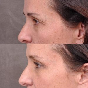 Upper Blepharoplasty and Endoscopic Brow Lift - Left Side