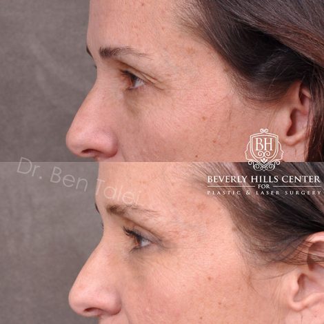 Upper Blepharoplasty and Endoscopic Brow Lift - Left Side