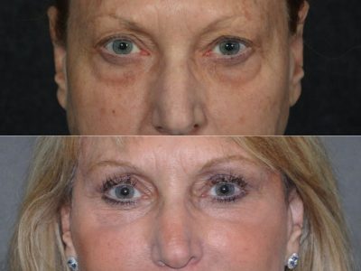 Lower Eyelid Rejuvenation - Front