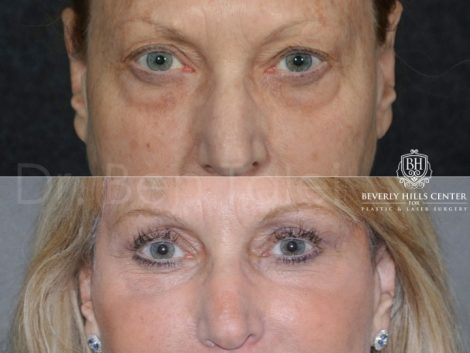 Lower Eyelid Rejuvenation - Front