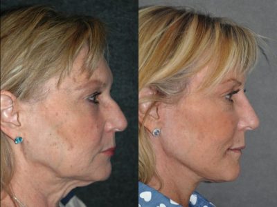 Liquid (Injectable Filler) Rhinoplasty - Right Side