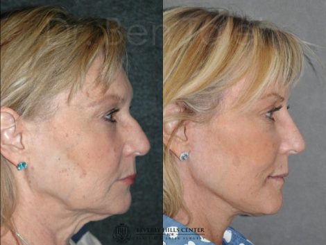 Liquid (Injectable Filler) Rhinoplasty - Right Side
