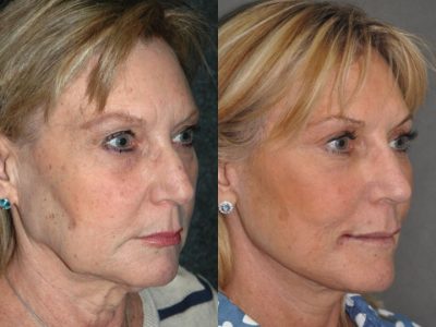 Liquid (Injectable Filler) Rhinoplasty - Right Side
