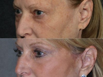Lower Eyelid Rejuvenation - Left Side