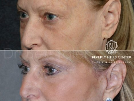Lower Eyelid Rejuvenation - Left Side