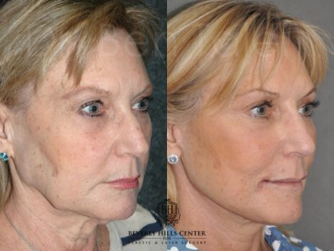 Beverly Hills Center Female Patient Before and After Non-surgical Liquid Rhinoplasty