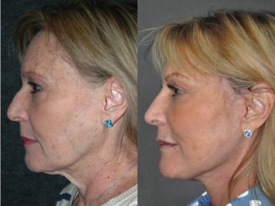 Liquid (Injectable Filler) Rhinoplasty - Left Side
