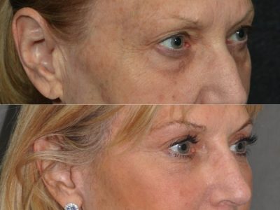 Lower Eyelid Rejuvenation - Right Side