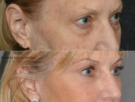 Lower Eyelid Rejuvenation - Right Side
