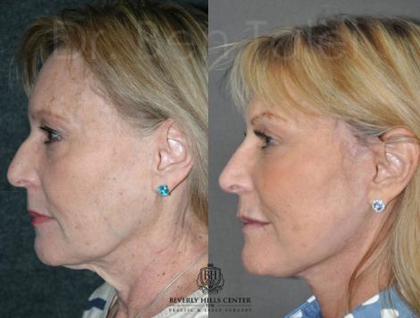 Beverly Hills Center Female Patient Before and After Non-surgical Liquid Rhinoplasty