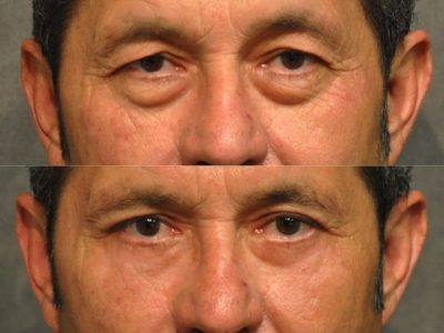 Upper & Lower Eyelid Rejuvenation - Front