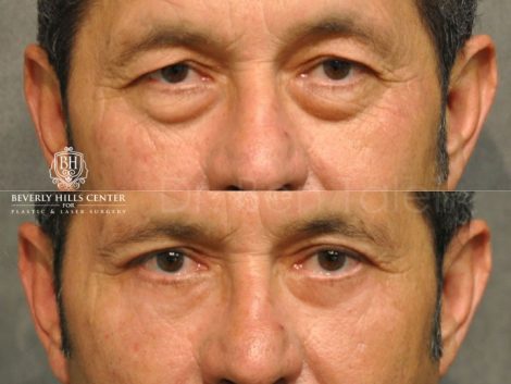 Upper & Lower Eyelid Rejuvenation - Front