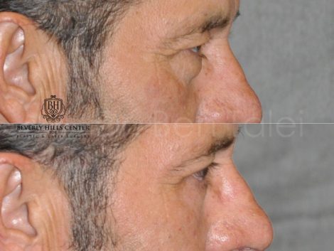 Upper & Lower Eyelid Rejuvenation - Right Side