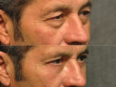 Upper & Lower Eyelid Rejuvenation - Right Side