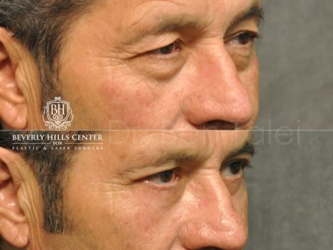 Upper & Lower Eyelid Rejuvenation - Right Side