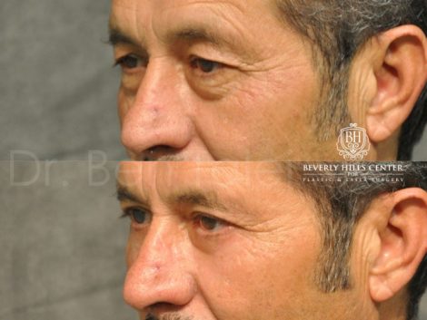 Upper & Lower Eyelid Rejuvenation - Left Side