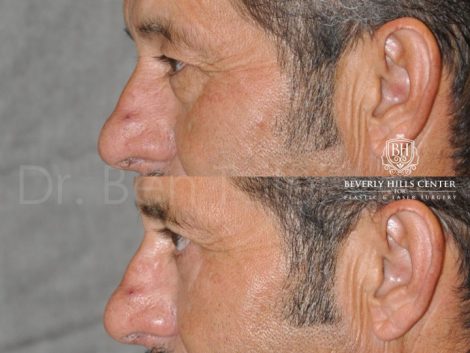 Upper & Lower Eyelid Rejuvenation - Left Side