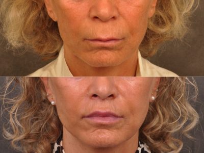 Modified Upper Lip Lift - Front