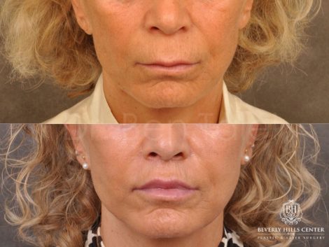 Modified Upper Lip Lift - Front