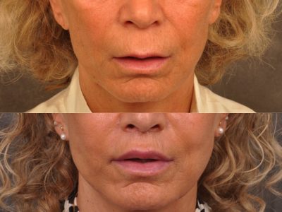 Modified Upper Lip Lift - Front