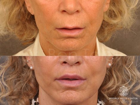 Modified Upper Lip Lift - Front