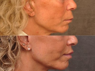 Modified Upper Lip Lift - Right Side