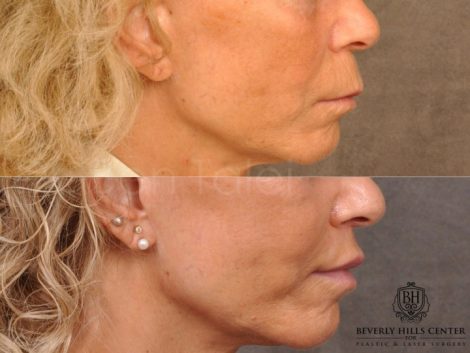 Modified Upper Lip Lift - Right Side