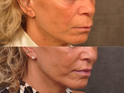 Modified Upper Lip Lift - Right Side