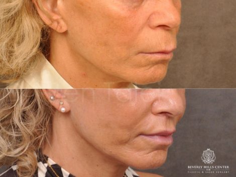 Modified Upper Lip Lift - Right Side
