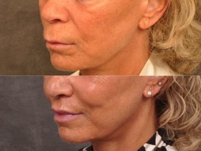 Modified Upper Lip Lift - Left Side
