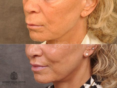 Modified Upper Lip Lift - Left Side