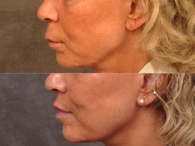 Modified Upper Lip Lift - Left Side