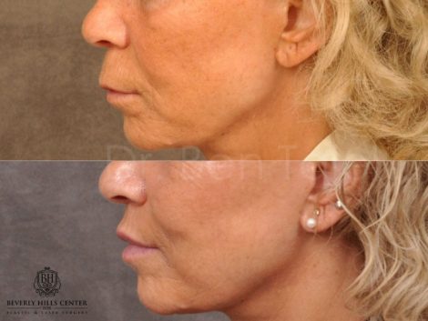 Modified Upper Lip Lift - Left Side