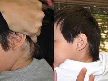 pediatric patient before and after birthmark removal