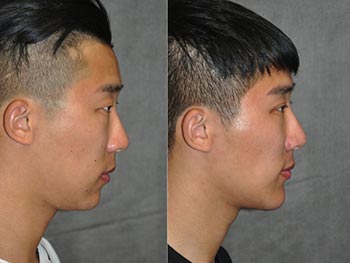 Beverly Hills Center Male Patient Before and After Chin Procedure