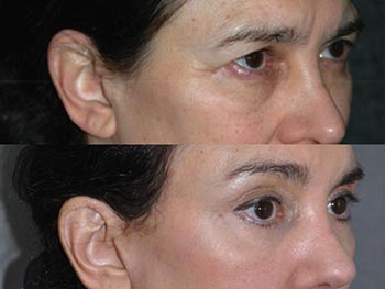 Beverly Hills Center Female Patient Before and After Brow Lift and Eye Rejuvenation Procedure